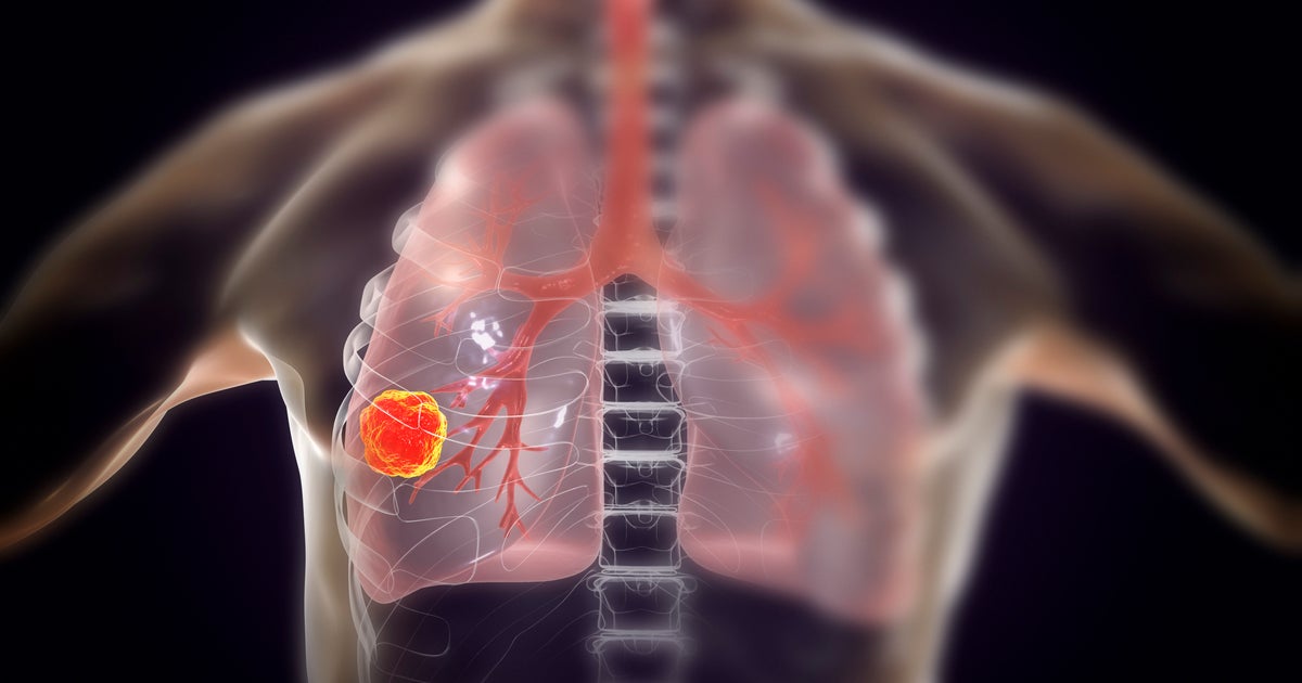 Desarrollan un test que detecta el cáncer de pulmón cuatro años antes que las técnicas actuales