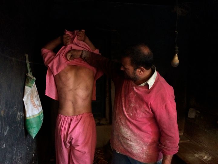In this Monday, Aug. 26, 2019, photo, a Kashmiri baker Sonaullah Sofi lifts the shirt from his son's back to show torture marks allegedly caused by Indian army soldiers at their bakery in southern village of Parigam.