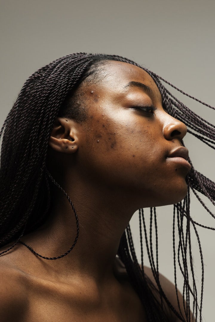 Sophie Harris-Taylor created a photography series that highlights faces with skin conditions such as acne, rosacea and eczema.