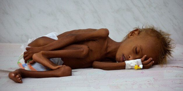 Salem Abdullah Musabih, 6, lies on a bed at a malnutrition intensive care unit at a hospital in the Red Sea port city of Hodaida, Yemen September 11, 2016. REUTERS/Abduljabbar Zeyad TPX IMAGES OF THE DAY SEARCH
