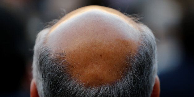 A man with baldness is seen in Seville, southern Spain April 6, 2016. REUTERS/Marcelo del Pozo