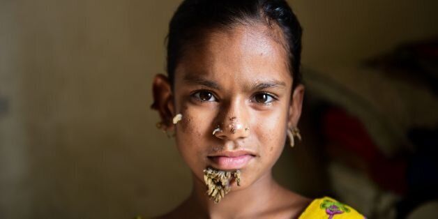 TOPSHOT - In this photograph taken on January 30, 2017, Bangladeshi patient Sahana Khatun, 10, poses for a photograph at the Dhaka Medical College and Hospital.A young Bangladeshi girl with bark-like warts growing on her face could be the first female ever afflicted by so-called 'tree man syndrome', doctors studying the rare condition said January 31. Ten-year-old Sahana Khatun has the tell-tale gnarled growths sprouting from her chin, ear and nose, but doctors at Dhaka's Medical College Hospita