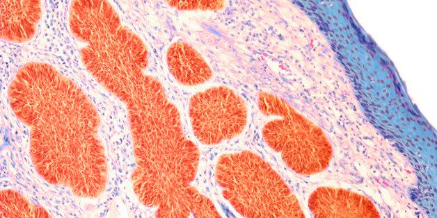Skin cancer. Light micrograph of a section through a basal cell carcinoma (rodent ulcer) a skin cancer. Magnification: x80 when printed at 10 centimetres wide.