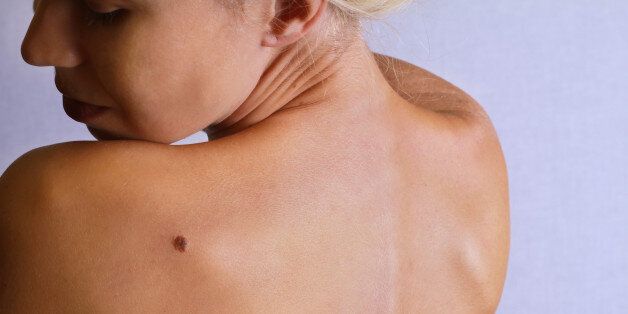 Young woman lookimg at birthmark on her back, skin. Checking benign moles