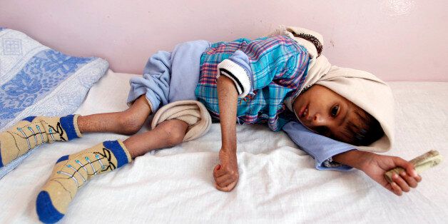 A malnourished Yemeni boy receives treatment at a therapeutic feeding centre in the capital Sanaa on October 29, 2016. / AFP / MOHAMMED HUWAIS (Photo credit should read MOHAMMED HUWAIS/AFP/Getty Images)