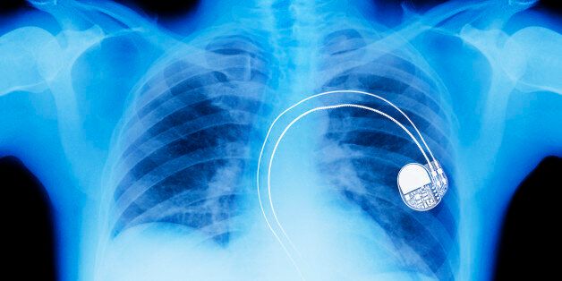 X-ray of cardiac pacemaker