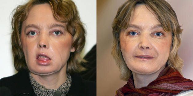 (FILES) - Combo of pictures (dated, at L 06 February 2006, at R from November 2006) of French Isabelle Dinoire, 39, a few months after her surgery operation carried out jointly by an Amiens and Lyon team who underwent the world's first facial face transplant, and a year later. When Isabelle Dinoire received the transplant, doctors warned she might never be able to kiss again. Now the 40-year-old French woman can eat, speak and smile normally, according to 'Isabelle's Kiss,' a book on her odyssey released this week. Mixing narrative and interviews with Dinoire, the book takes the reader from the day the young woman was rushed to hospital in May 2005 after being disfigured by her dog, to the press conference the following February at which she revealed her new face to the world. AFP PHOTO DENIS CHARLET (L) AFP PHOTO-CENTRE HOSPITALIER UNIVERSITAIRE AMIENRS (CHU AMIENS) (R) (Photo credit should read DENIS CHARLET/AFP/Getty Images)