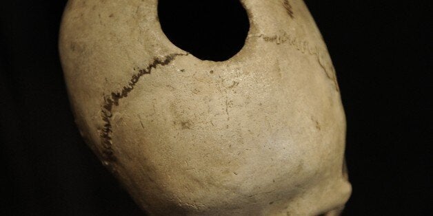 Trepanned skull. From a grave in Naes, Falster. Neolithic. National Museum of Denmark. Copenhagen. Denmark. (Photo by: Prisma/UIG via Getty Images)