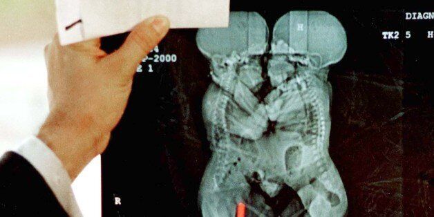 A doctor shows an X-ray of Colombian siamese twins in the city of Medellin , September 14, 2000. An infant Colombian Siamese twin died early on Thursday, less than 24 hours after doctors separated her from her sister in a risky and complicated operation. Doctors at the state-run Leon XIII hospital said the baby, who was less than a week old, died of respiratory failure after a 16-1/2 hour operation that began on Tuesday afternoon to separate her from the sister with whom she shared a liver, part of her intestines and pancreas.