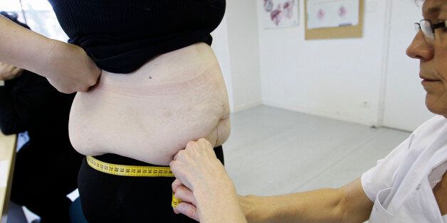 A nurse measures an obese patient at the office of surgeon Dr. Alexandre Lesage's to prepare for surgery at the Saint Jean d'Angely Hospital, in Saint Jean d'Angley, southwestern France, January 24, 2013. The patient hopes to lose some 50 kilos (110 pounds) in the next year after she undergoes surgery for obesity. Picture taken January 24, 2013. REUTERS/Regis Duvignau (FRANCE - Tags: HEALTH)