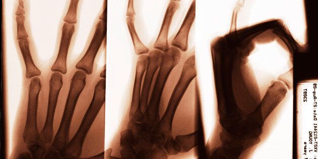 missing papers, so cleaning, finding the old scans of my reclaimed x-ray (in case of returns) of my finger as it was the day after it was broken.as far as i know it's still in two.but look how pretty my bones are! :D