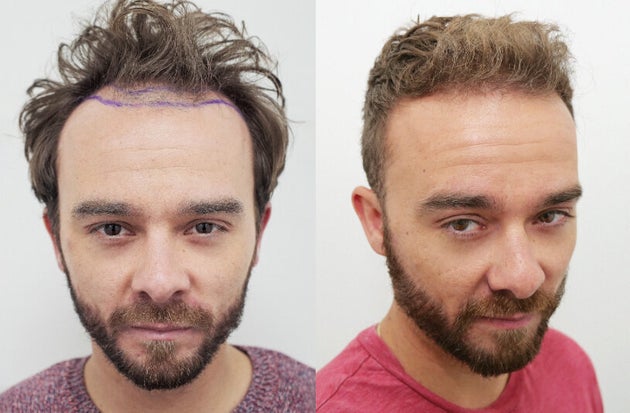 coronation street s jack p shepherd unveils results of hair transplants results