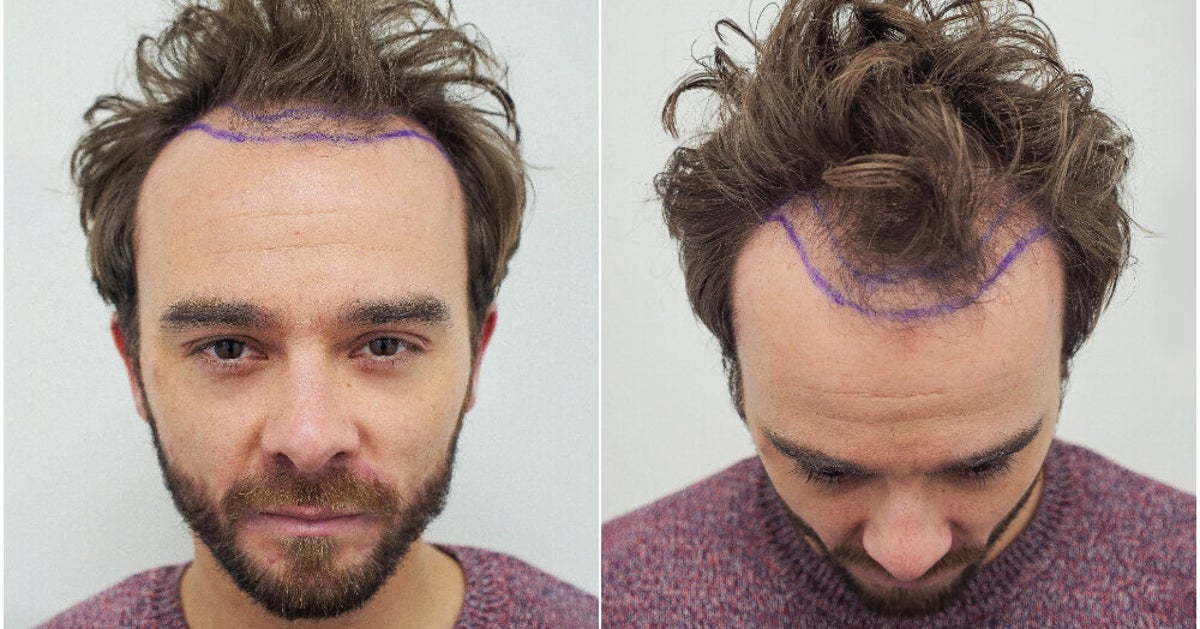 Coronation Street's Jack P Shepherd Unveils Results Of Hair Transplant