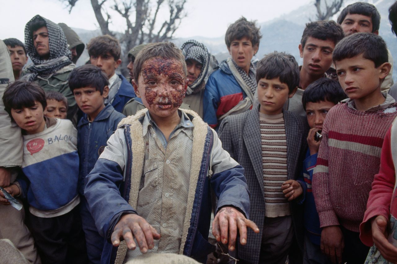 Αγόρι στο Ιράκ που φέρει εγκαύματα από τη χρήση χημικών όπλων. Ένα από τα λιγοστά δημοσιευμένα ντοκουμέντα της χρήσης απαγορευμένων όπλων από τον ιρακινό στρατό σε βάρος των Κούρδων του Ιράκ (1991)