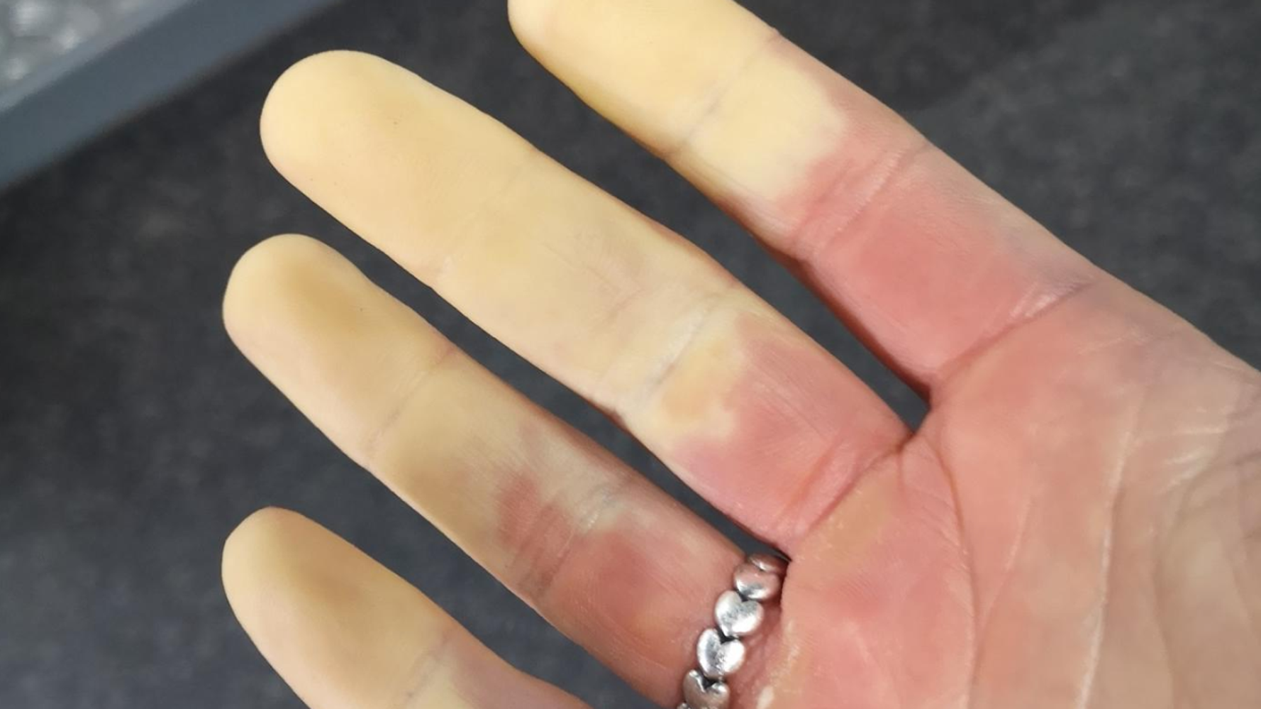 Raynmauds Raynaud's Disease Impacts 1 In 5 People – But Many Have Never Heard Of ...