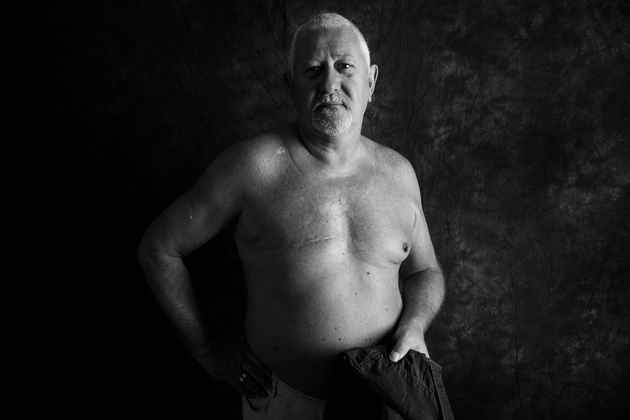 Steve McAllister, 67, from Cardiff, was diagnosed with breast cancer in 2010.