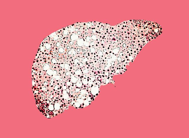 Liver Cancer Symptoms And Risks Explained, As Deaths Reach Record High