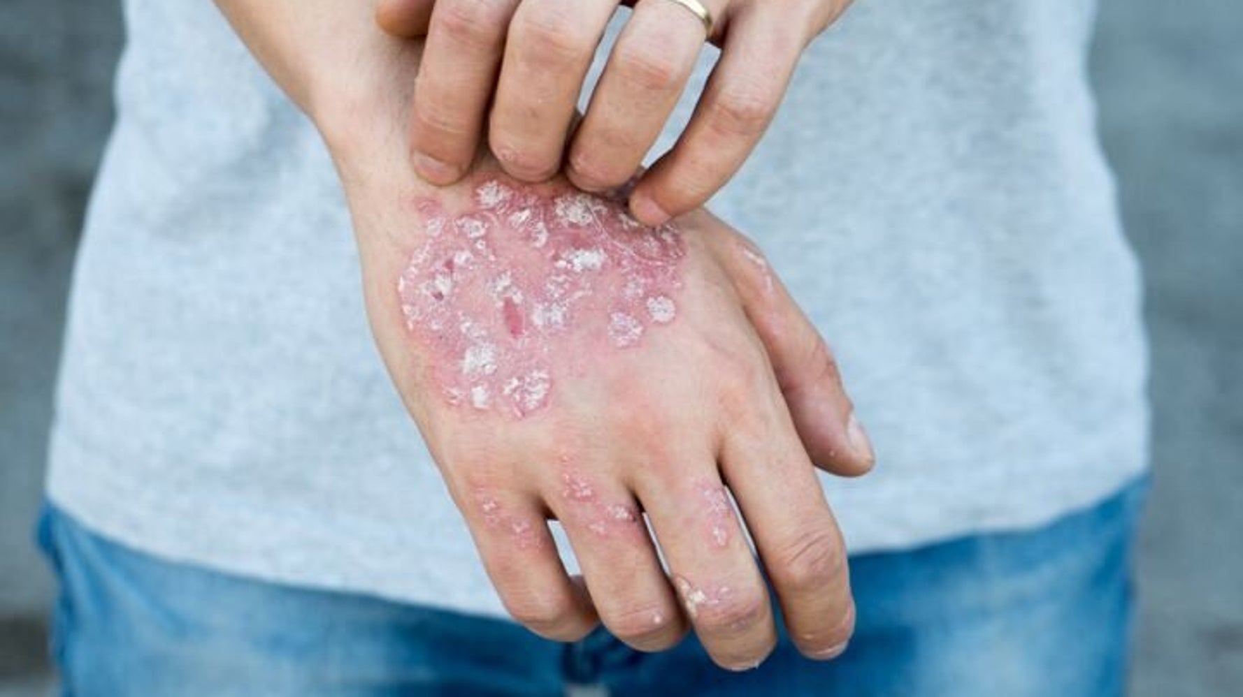 Seis Cosas Que La Gente Con Psoriasis Quiere Que Sepas El Huffpost Life