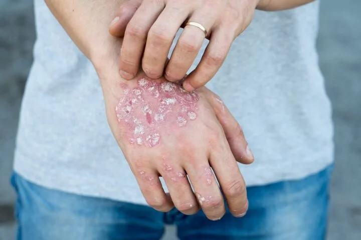 Seis Cosas Que La Gente Con Psoriasis Quiere Que Sepas El Huffpost Life