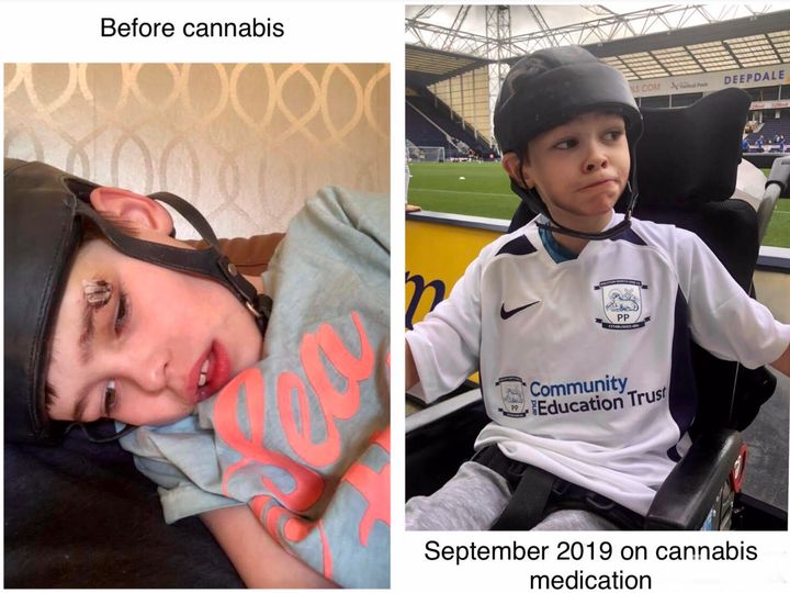 Ben - before and after taking medical cannabis