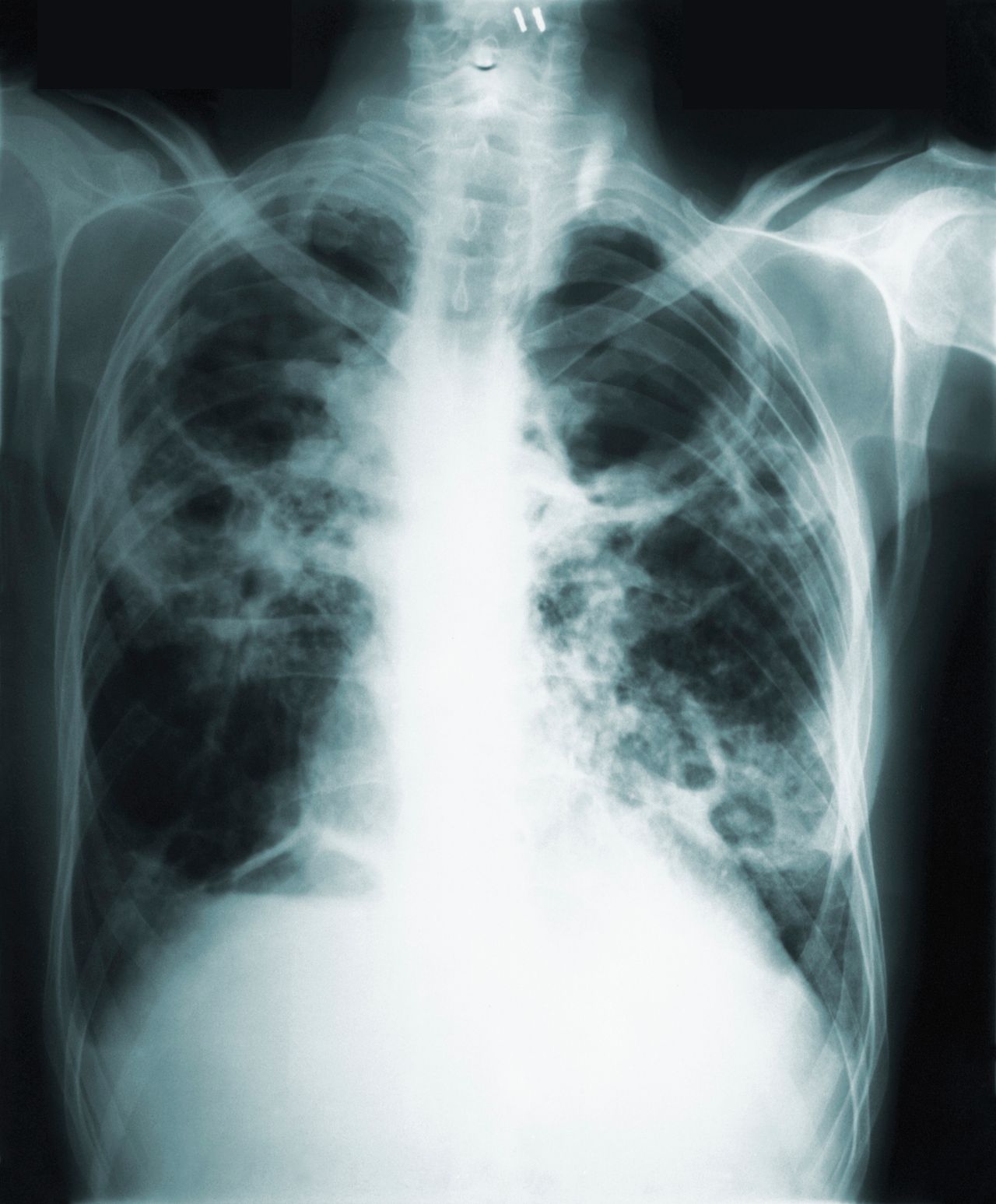 This 1966 image made available by the Centers of Disease Control and Prevention shows a chest x-ray of a tuberculosis patient.