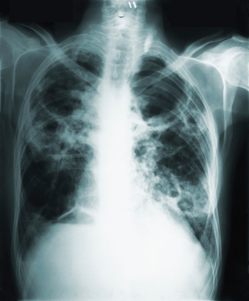 This 1966 image made available by the Centers of Disease Control and Prevention shows a chest x-ray of a tuberculosis patient