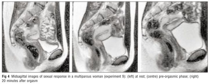 MRI images of sexual response in a woman who has previously given birth. Left, at rest; centre, at pre-orgasmic phase; and right, 20 minutes after orgasm.