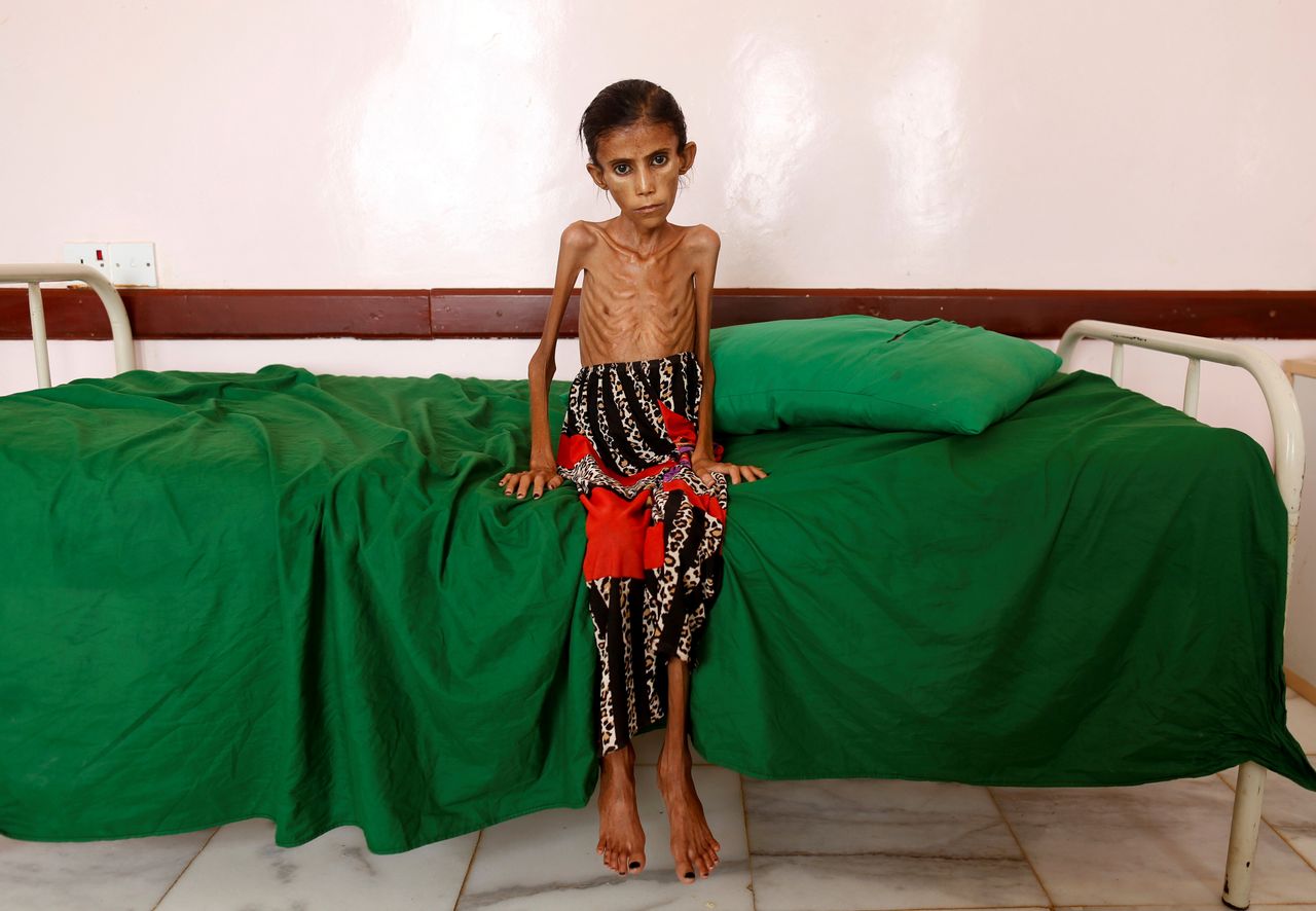 Η αποστεωμένη Φατίμα Ιμπραήμ Χαντί, 12 ετών, που ζυγίζει μόνο 10 κιλά, σε μια κλινική στο Ασλάμ, Υεμένη, 17 Φεβρουαρίου 2019. 