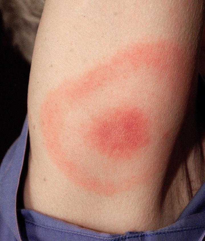 Sarpullido de la enfermedad de Lyme.
