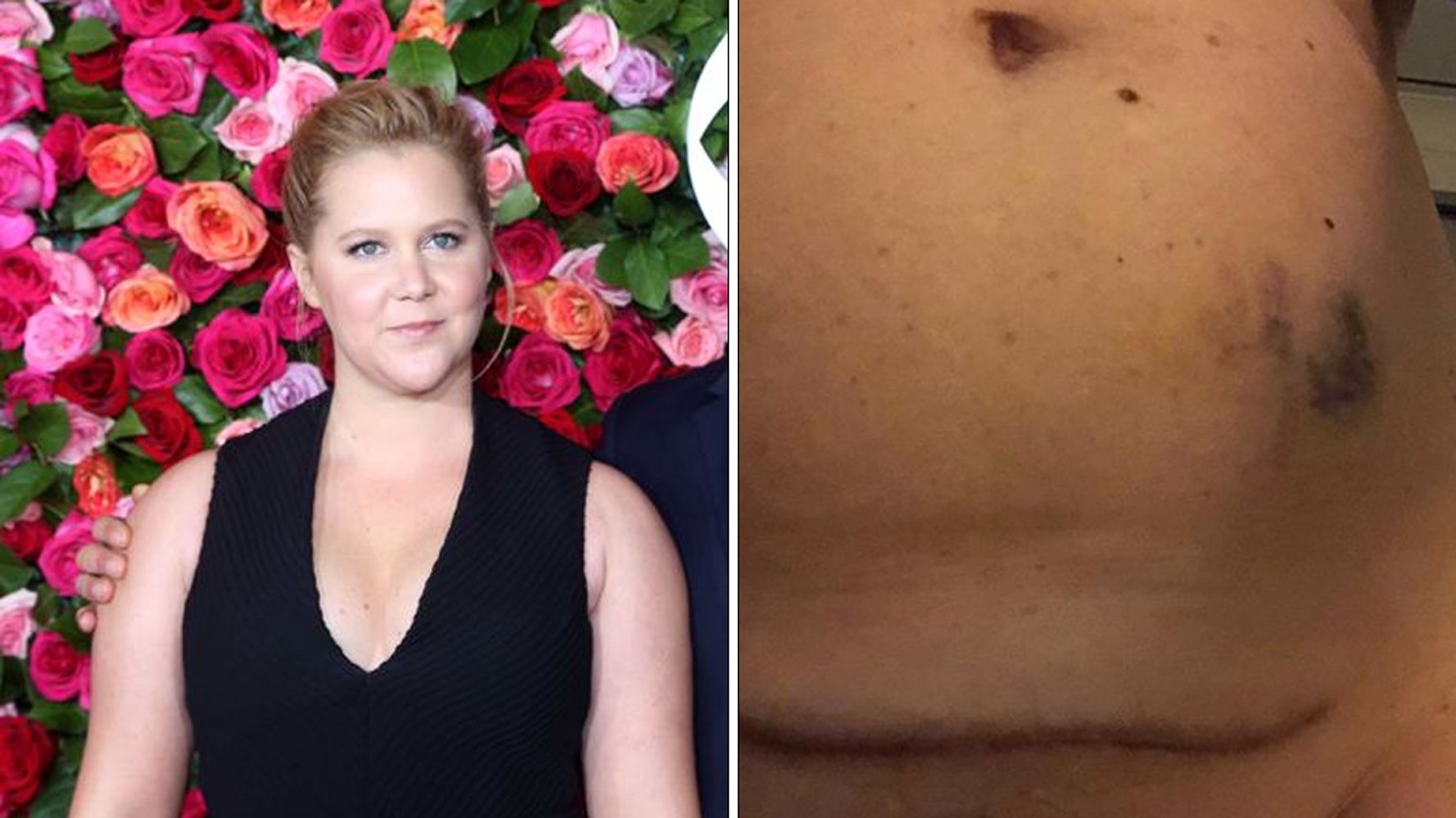 Amy Schumer Shows Us What Having Ivf Actually Looks Like In Candid Instagram Post Huffpost Uk Parents