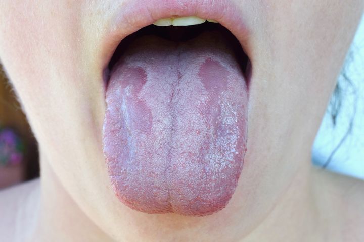Hpv yellow tongue