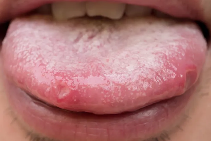 Wart on tongue child
