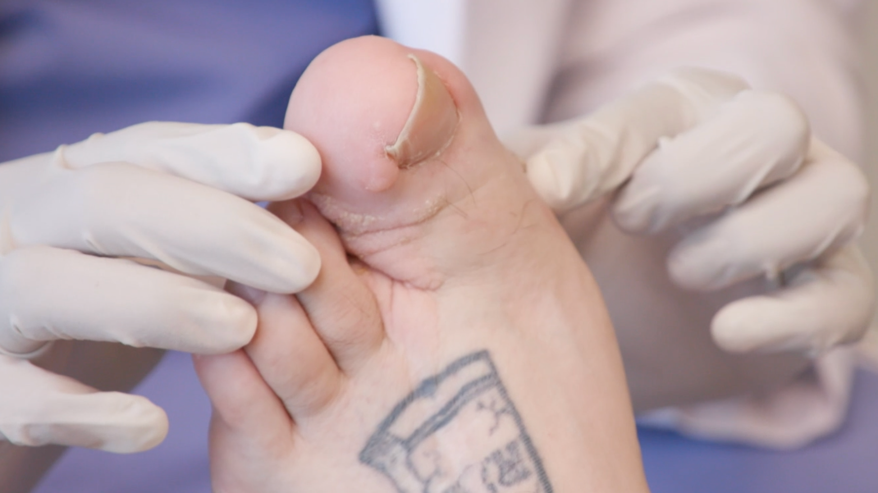 Man Suffers From Really Huge Big Toe On Tlc S My Feet Are Killing Me Huffpost Null Man Suffers From Really Huge Big Toe On Tlc S My Feet Are Killing Me Huffpost Null