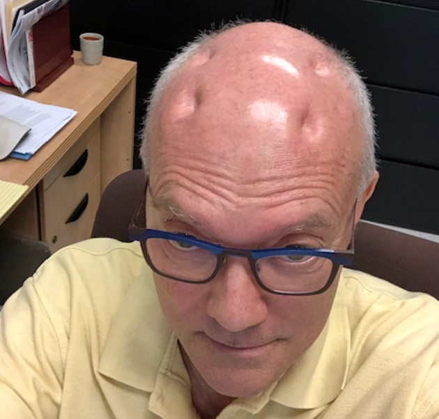 I Suddenly Have 4 Severe Dents In My Head And I'm Trying To Accept My New Appearance | HuffPost I Suddenly Have 4 Severe Dents In My Head And I'm Trying To Accept My New Appearance | HuffPost