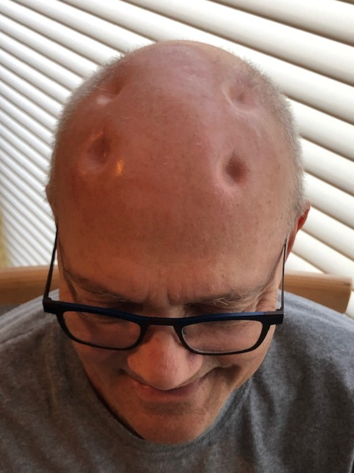 A photo of Felice's head taken in February 2020.