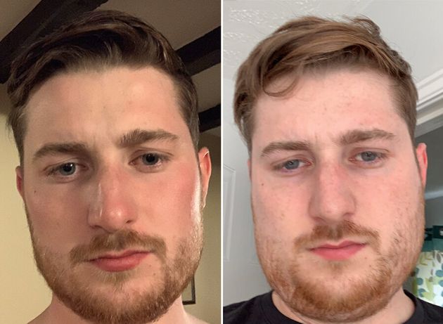 The photo on the right shows Shaun with mumps. 