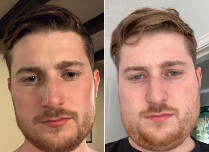 The photo on the right shows Shaun with mumps. 