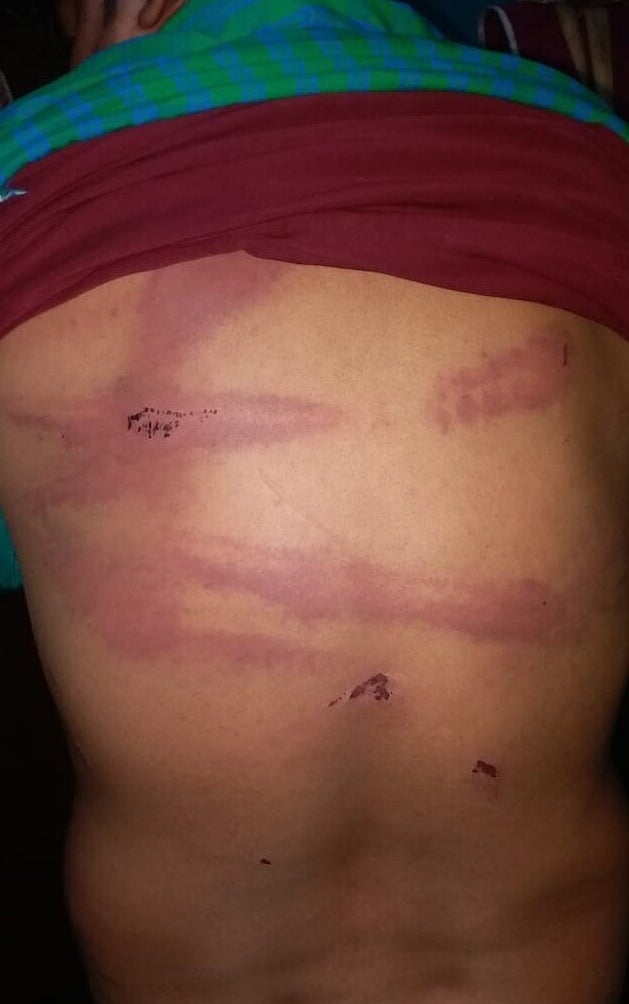 Bruises on the back of the second eyewitness. He was not in the national anthem video, but said he was also assaulted by the Delhi Police on February 24.