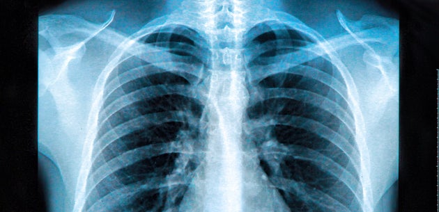 Uno Studio Mostra I Danni Ai Polmoni Dei Primi Malati Di Coronavirus Curati In Italia L Huffpost