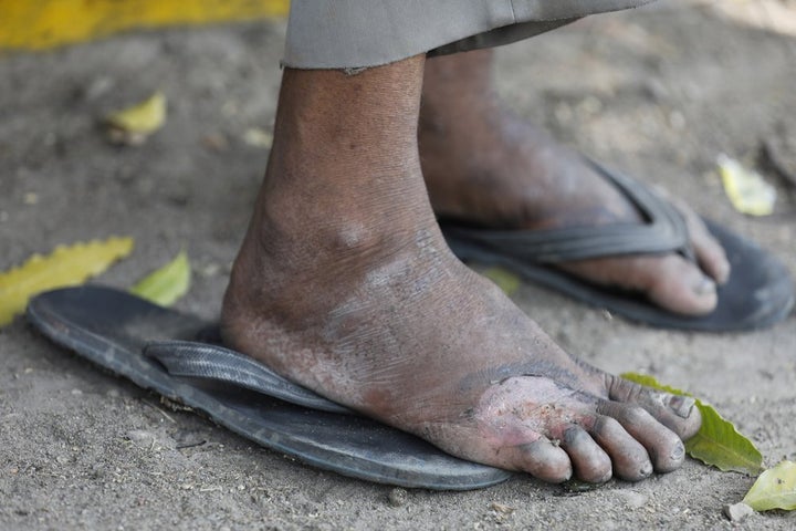 In this Monday, March 30, 2020, photo, an injured foot of a daily wage laborer is seen as he rests on way to his village on the outskirts of Prayagraj, India. 