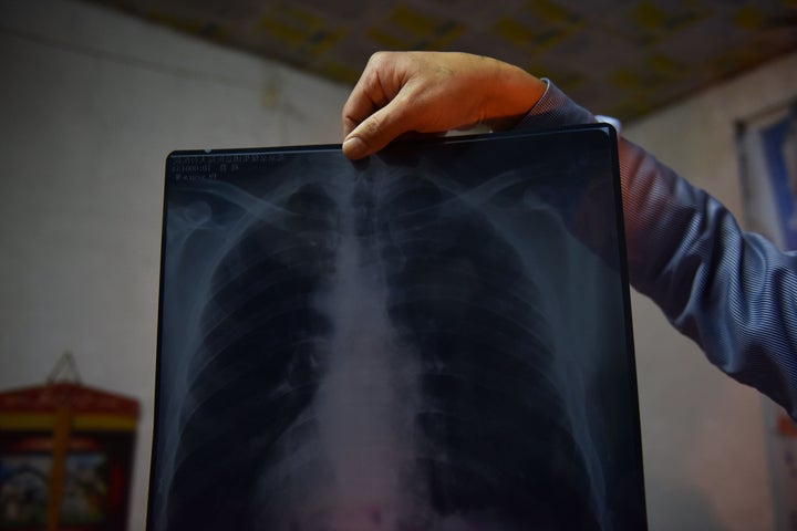 At least <a href="https://www.cdc.gov/niosh/updates/upd-07-20-18.html" target="_blank" role="link" class=" js-entry-link cet-external-link" data-vars-item-name="one in 10 underground miners has black lung" data-vars-item-type="text" data-vars-unit-name="5e862723c5b6a949183323d7" data-vars-unit-type="buzz_body" data-vars-target-content-id="https://www.cdc.gov/niosh/updates/upd-07-20-18.html" data-vars-target-content-type="url" data-vars-type="web_external_link" data-vars-subunit-name="article_body" data-vars-subunit-type="component" data-vars-position-in-subunit="3">one in 10 underground miners has black lung</a>, according to the Centers for Disease Control and Prevention.