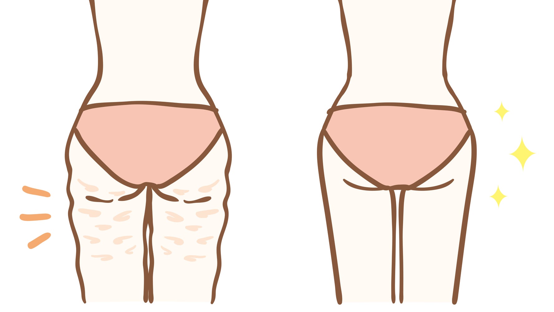 Do Cellulite Creams Even Work Huffpost Life