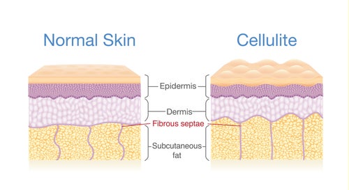 Cellulite forms when the connective tissues (made of collagen) between your muscle and skin squeeze fat cells toward your epidermis, creating a bumpy, dimpled appearance.