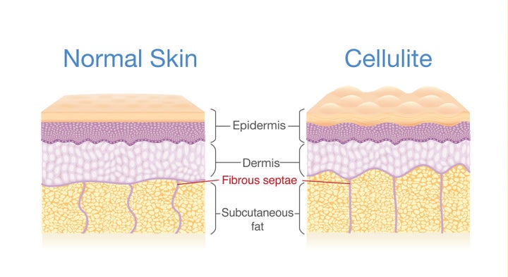 Cellulite entsteht, wenn das Bindegewebe (aus Kollagen) zwischen Muskeln und Haut Fettzellen an die Haut drückt, wodurch ein holpriges, grübchenförmiges Erscheinungsbild entsteht.