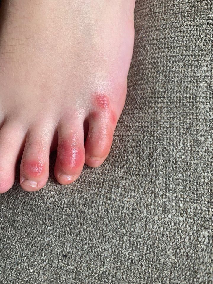 A teenage patient's foot with the condition many are calling "COVID toes," as taken in a photo by Dr. Amy Paller.