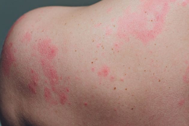These Skin Conditions Could Mean Youre Carrying Coronavirus