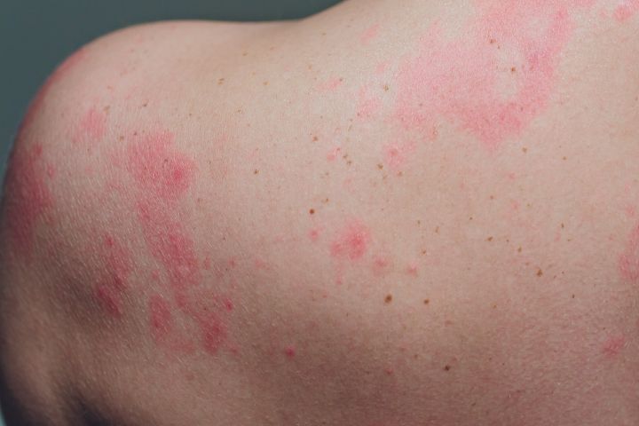 Doctors say COVID-related skin conditions may look like psoriasis or hives. 