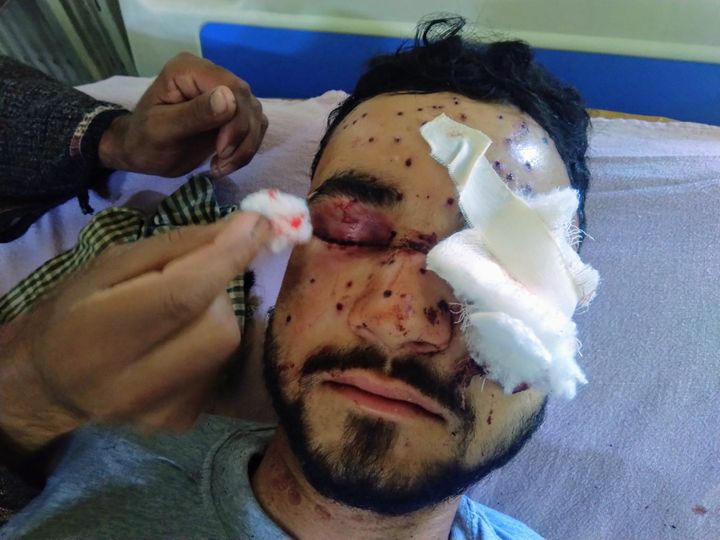 Omar Farooq, a 23-year-old college student, was hit by metal pellets in both eyes on 6 May, 2020 in Kashmir.