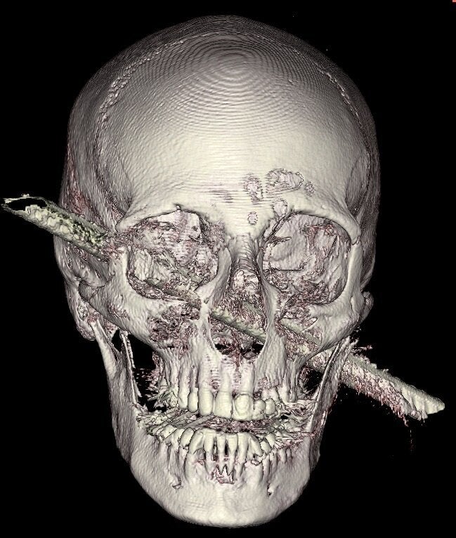 Surgeons at Israel's Hadassah Hospital Ein Kerem removed this iron rod from a man's skull.