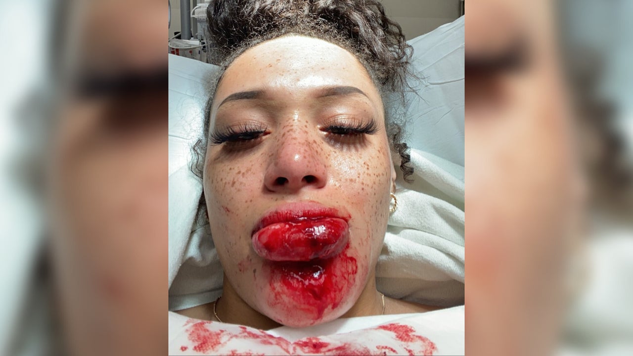 Amara Green took this selfie at an emergency room in Minneapolis about an hour after police shot her with a rubber bullet while she was attending a protest on May 27.